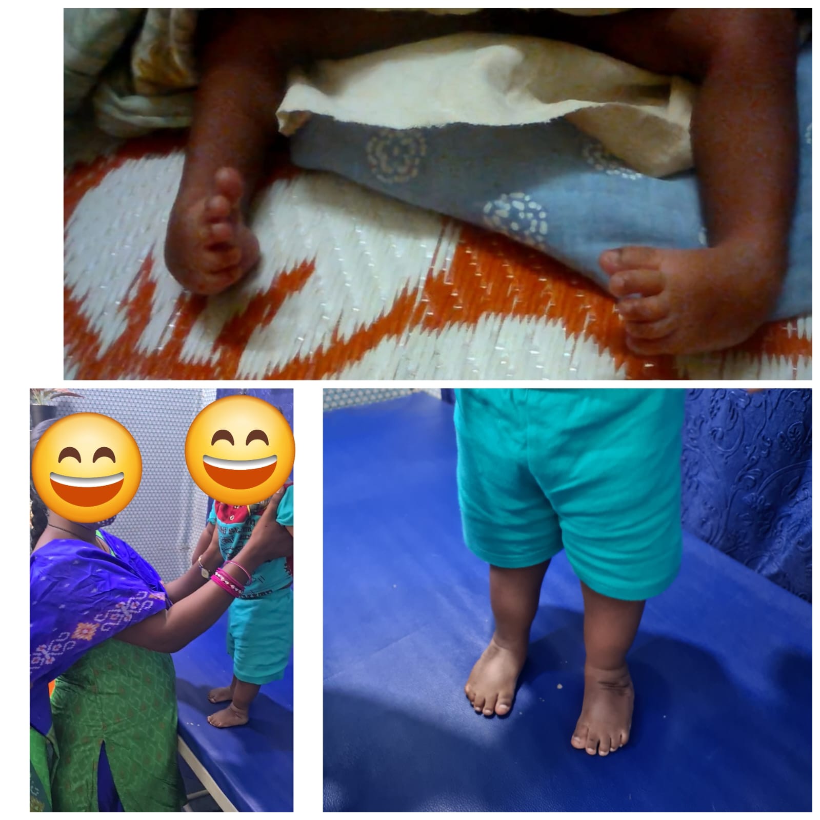 Clubfoot Treatment