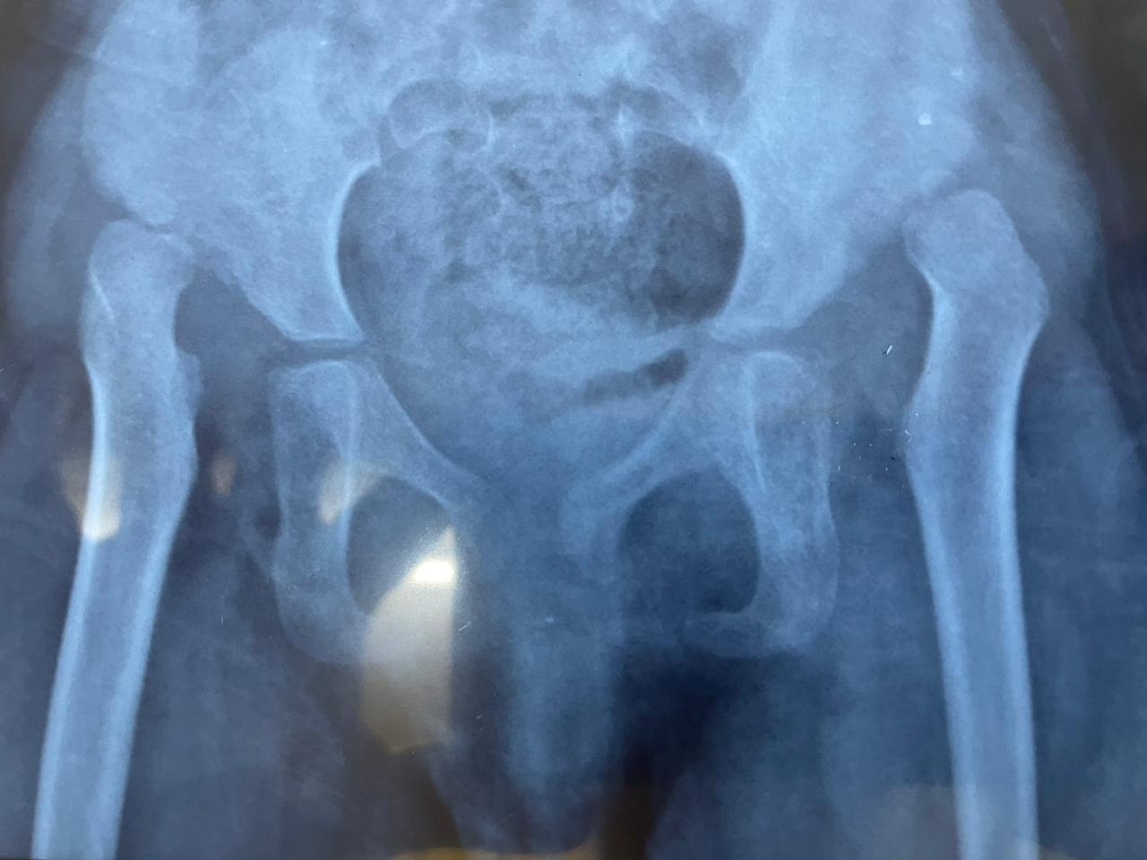 Developmental Dysplasia of the Hip