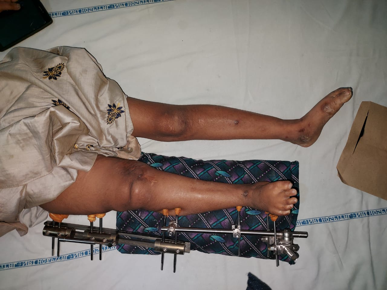 Limb Length Discrepancies