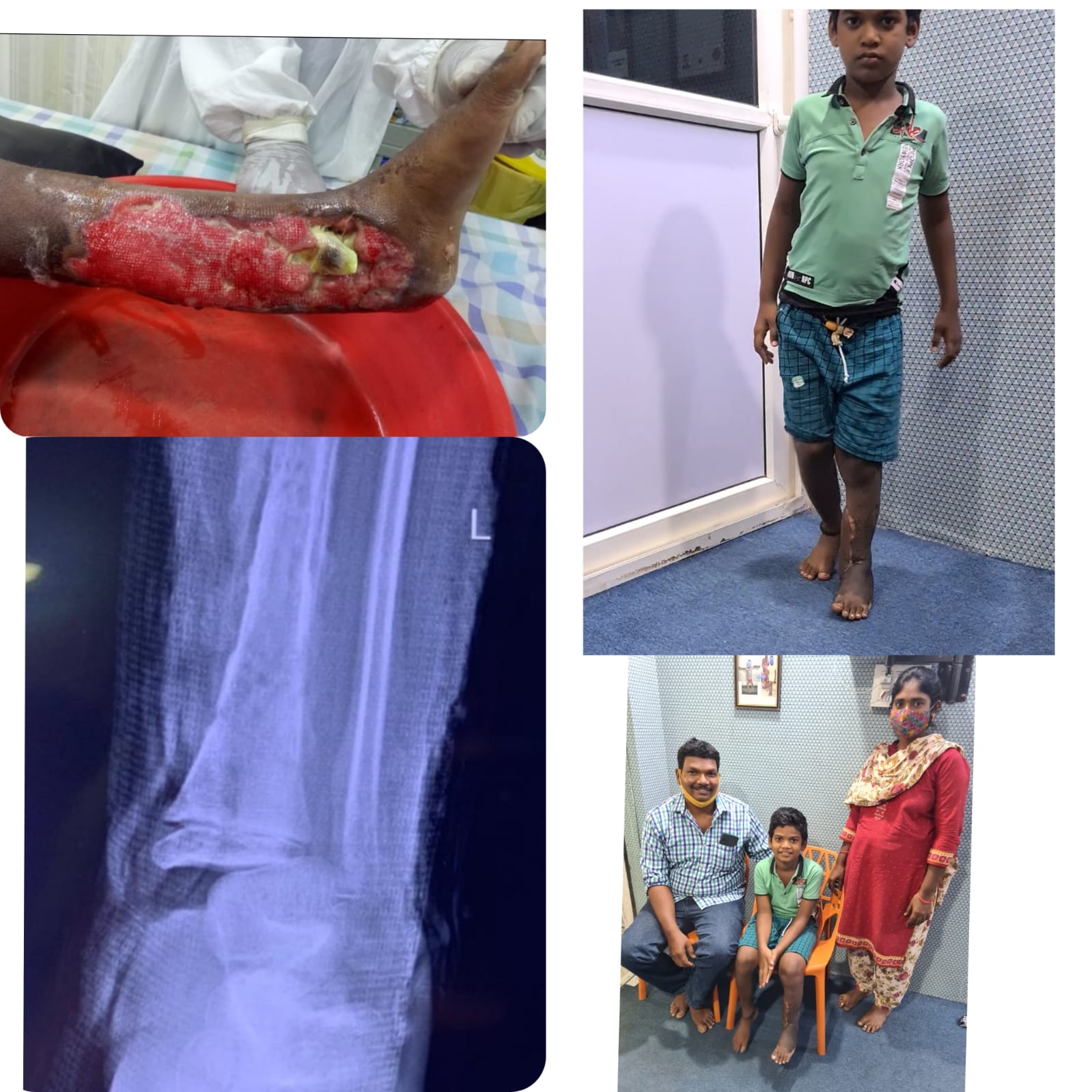 Musculoskeletal Infections