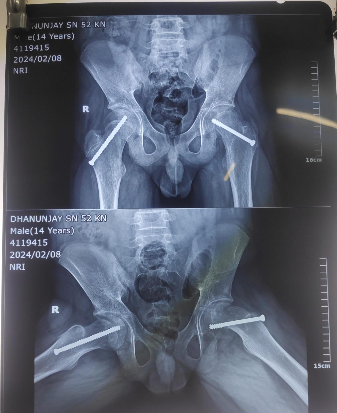Slipped Capital Femoral Epiphysis