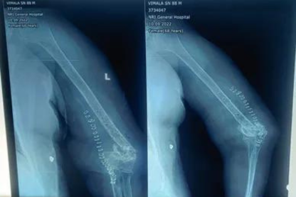 Revision & Complex Trauma